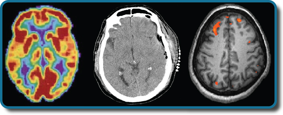 Three brain-imaging scans are shown. From the left, PET scan shows brain in color, middle image is a CT scan, and right image is a functional magnetic resonance imaging that shows the brain with a few spots of orange-ish red color.