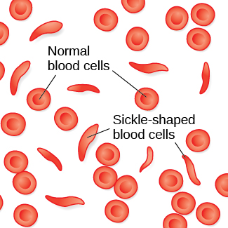 An illustration showing normal red blood cells, which are normally round, and sickle-cell blood cells that take on a crescent-like shape. The changed shape of these cells affects how they function: sickle-shaped cells can clog blood vessels and block blood flow, leading to high fever, severe pain, swelling, and tissue damage.