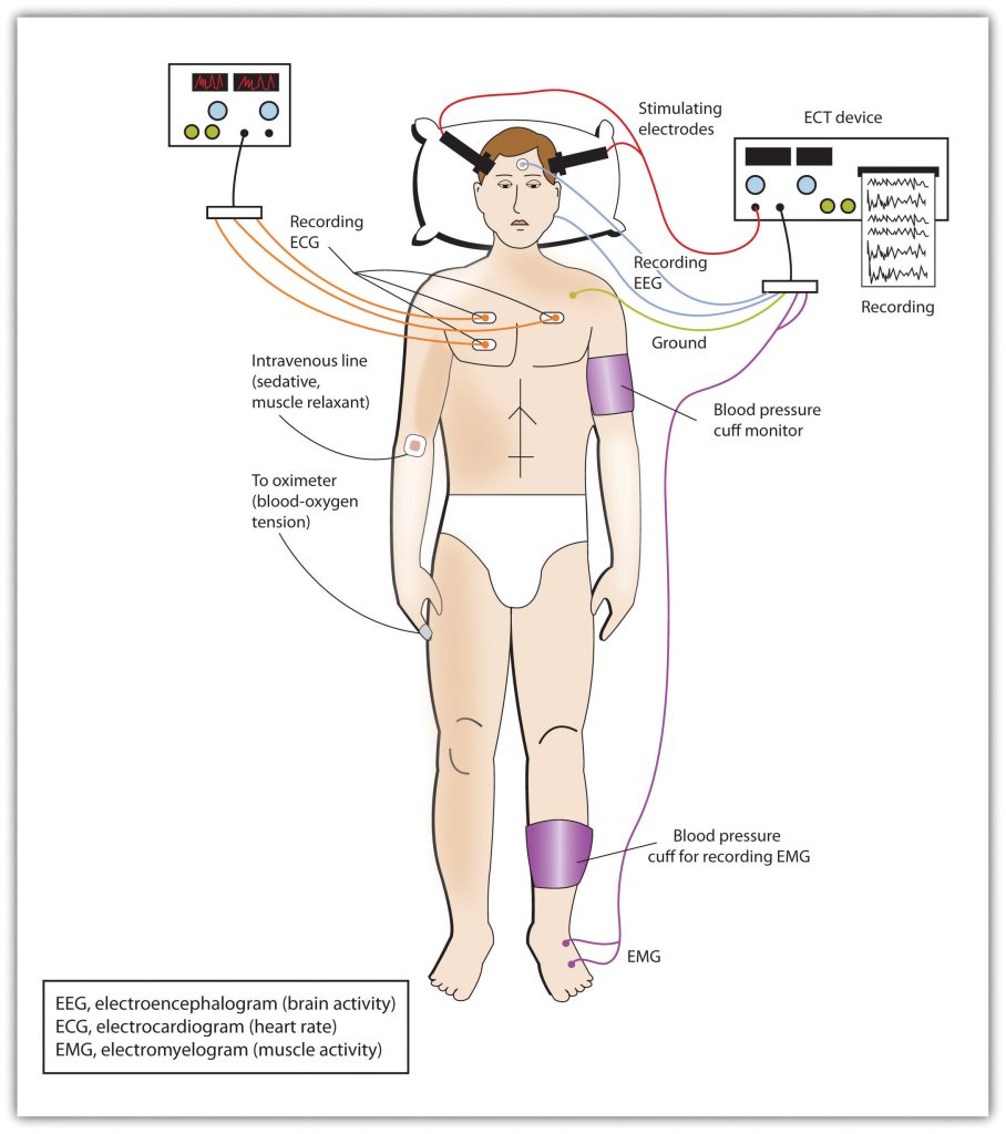 Illustration of Electroconvulsive Therapy (ECT)