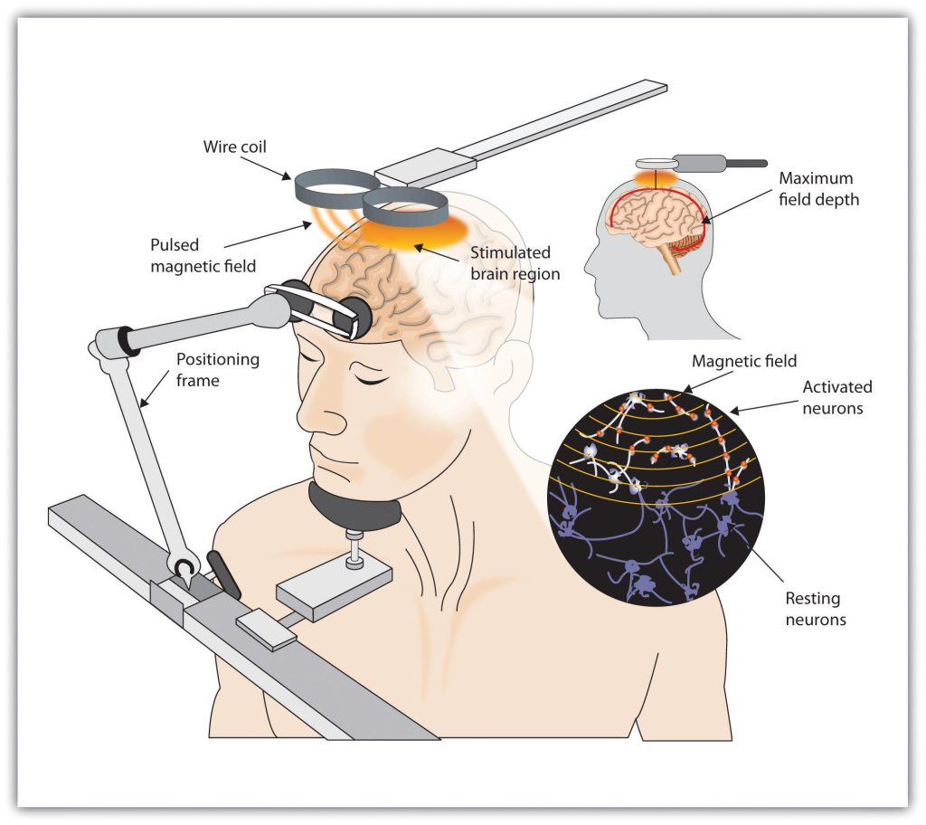 Illustration of Transcranial Magnetic Stimulation (TMS)