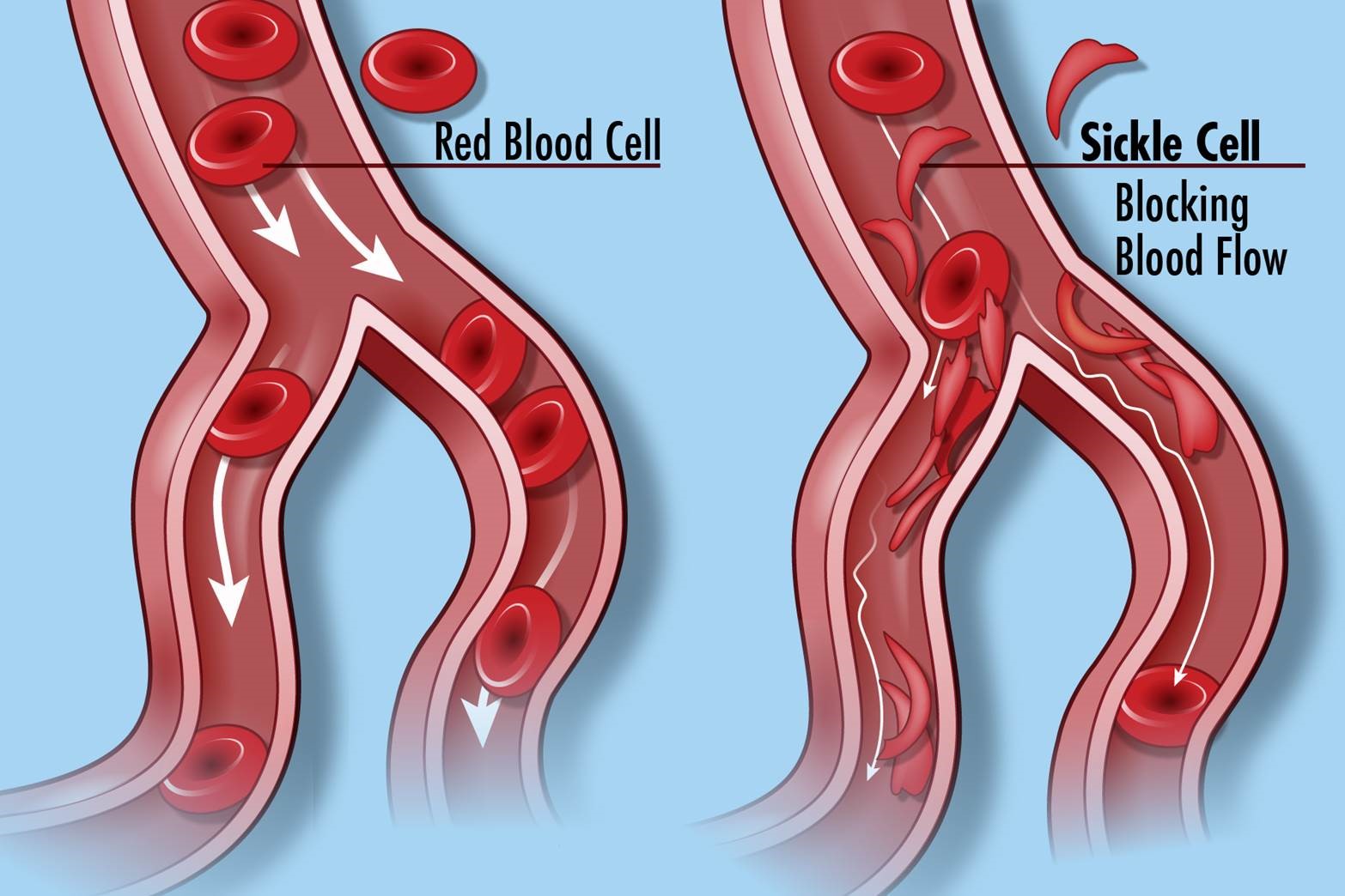 Schematic diagram of blood vessels comparing normal blood flow with round red blood cells and blocked blood flow in patient with sickle shaped red blood cells