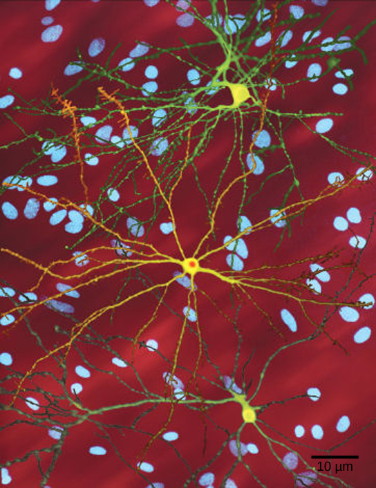 Micrograph shows a neuron with nuclear inclusions characteristic of Huntington's disease.