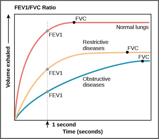 The graph plots volume exhaled versus time. In normal lungs, almost all of the air can be forcibly exhaled within one second after taking a deep breath, resulting in a curve that rises steeply at first then plateaus shortly after one second. The volume at which the plateau is reached is the F V C. In lungs of persons with restrictive lung disease, the F V C is considerably lower but the person can exhale reasonable fast, resulting in a curve that is similar in shape, but with a lower plateau, or F V C, than for normal lungs. In lungs of persons with obstructive lung disease, the F V C is low and exhalation is much slower, resulting in a flatter curve with a lower plateau.