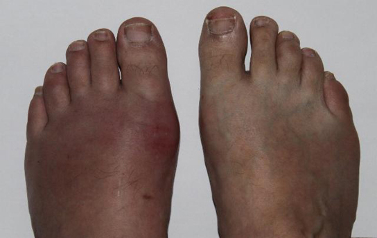 Photo shows a person's feet. One foot is swollen and red, while the other appears normal.