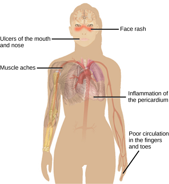 Illustration shows the symptoms of lupus, which include a face rash, ulcers in the mouth and nose, inflammation of the pericardium and poor circulation in the fingers and toes.