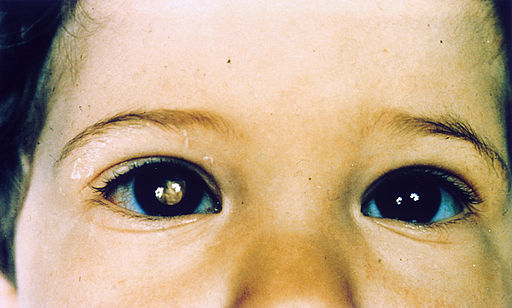 a child's face with a white light reflection in the right eye