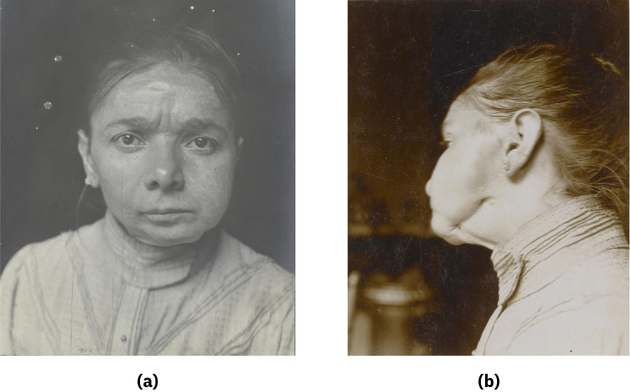 Photograph a shows a woman staring directly into the camera. A large portion of her lower jaw is missing. Photograph b shows the same woman from the side and provides another view of her abnormally shaped jaw.