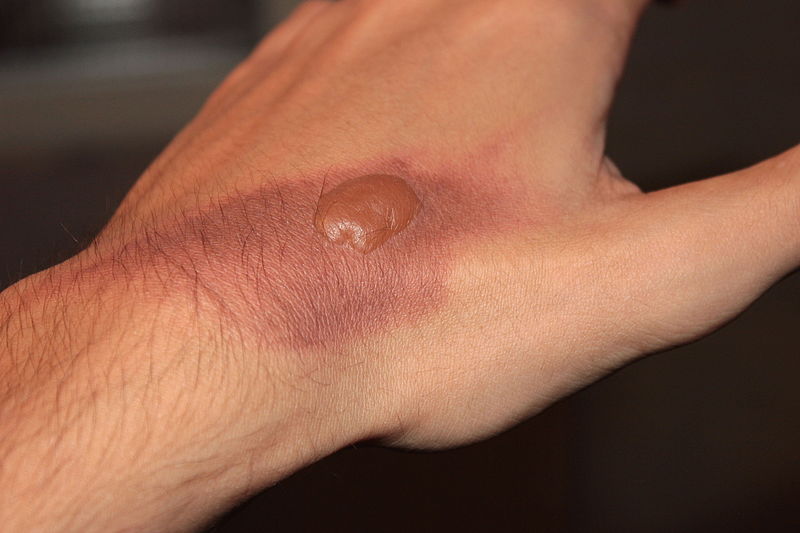 An example of a second degree burn reveals a swollen blister from the dermis surrounded by reddened epidermis.