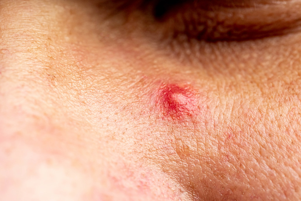 In contrast to the smooth surrounding skin, a pimple appears as an irritated, red bump on the surface of the skin.
