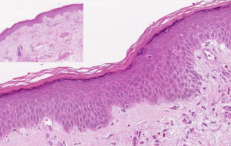 A section of skin viewed under a microscope that shows distinct keratinocytes packed tightly together into layers in the epidermis.