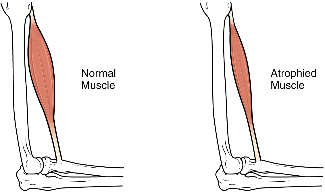 Normal muscle and atrophied muscle have the same origin and insertion, but the atrophied muscle is much thinner in thickness.