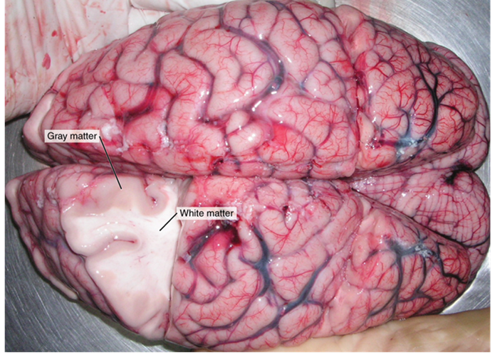 A photo of a brain from an autopsy. The highly folded cerebrum is seen covered by the arachnoid layer with surface blood vessels and capillaries visible. A section of cerebrum has been cut out showing the outer gray and inner white matter.