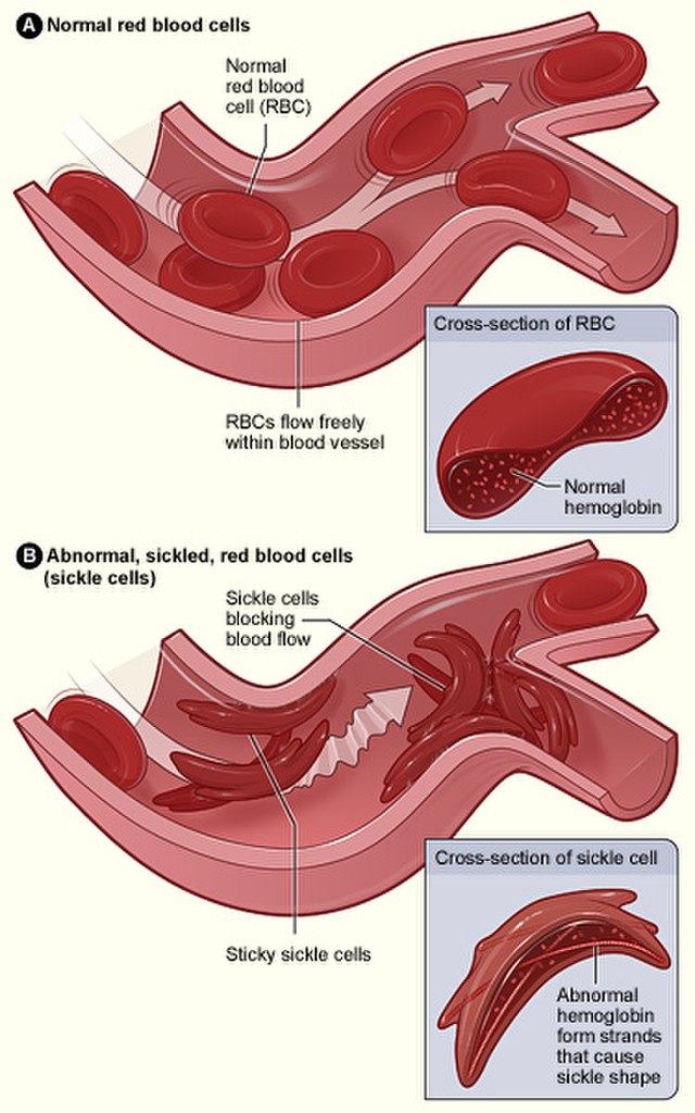 A shows normal red blood cells flowing freely in a blood vessel. The inset image shows a cross-section of a normal red blood cell with normal hemoglobin. Figure B shows abnormal, sickled red blood cells blocking blood flow in a blood vessel. The inset image shows a cross-section of a sickle cell with abnormal (sickle) hemoglobin forming abnormal strands.