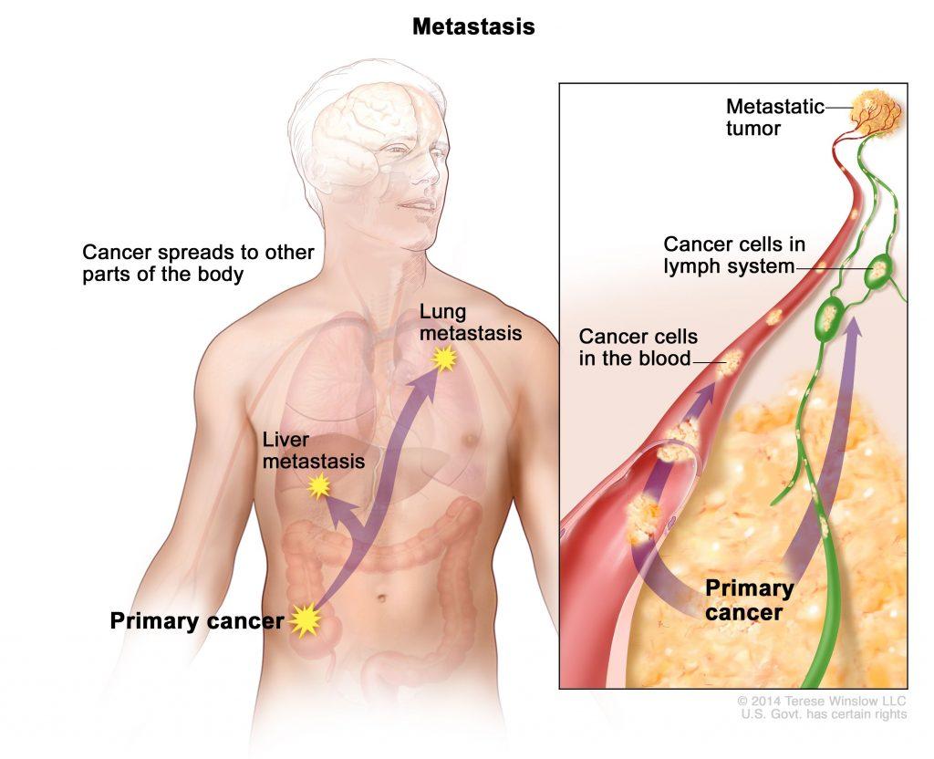 Diagram illustrates how cancers can metastasize.