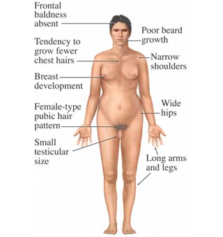 An illustration of the symptoms of Klinefelter's syndrome in a human male.