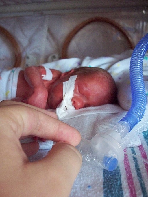 A photo shows a premature infant with a ventilator.