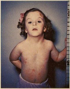 A photo from Sydney S. Gellis and Murray Feingold from Atlas of mental retardation syndromes showing a girl with Turner's syndrome.